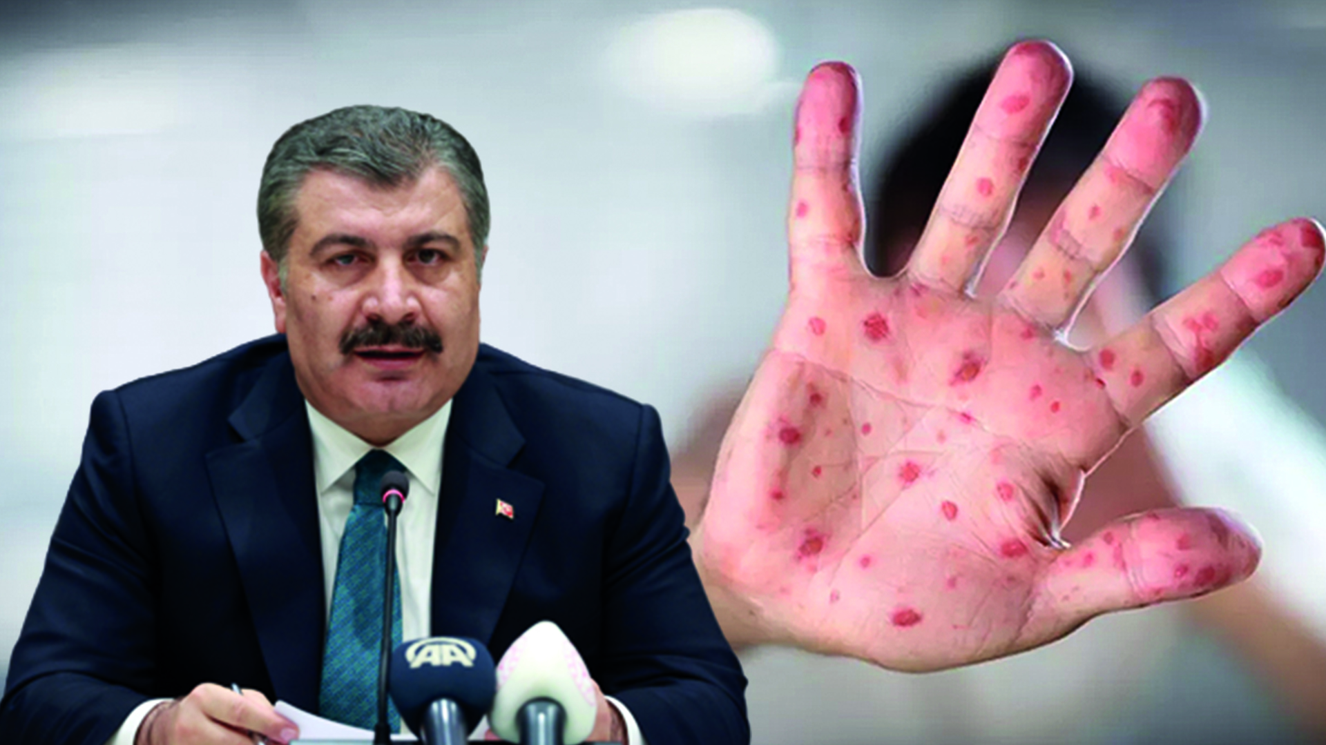 Sağlık Bakanı Fahrettin Koca, “Bir hastamızda maymun çiçeği hastalığı tespit